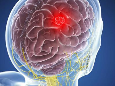 Waspadai Meningioma: Tumor Jinak dalam Otak